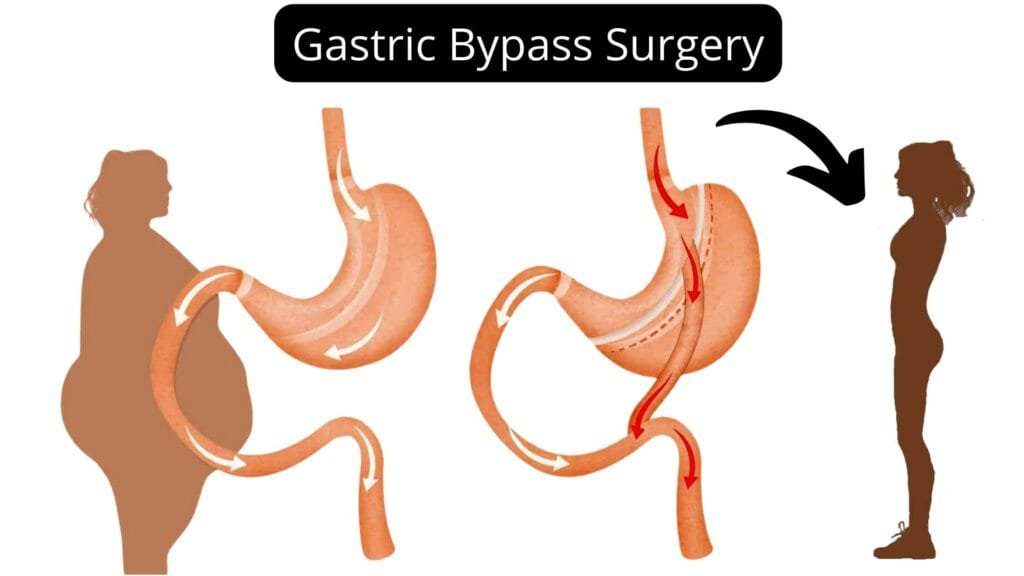 Gastric Bypass Surgery