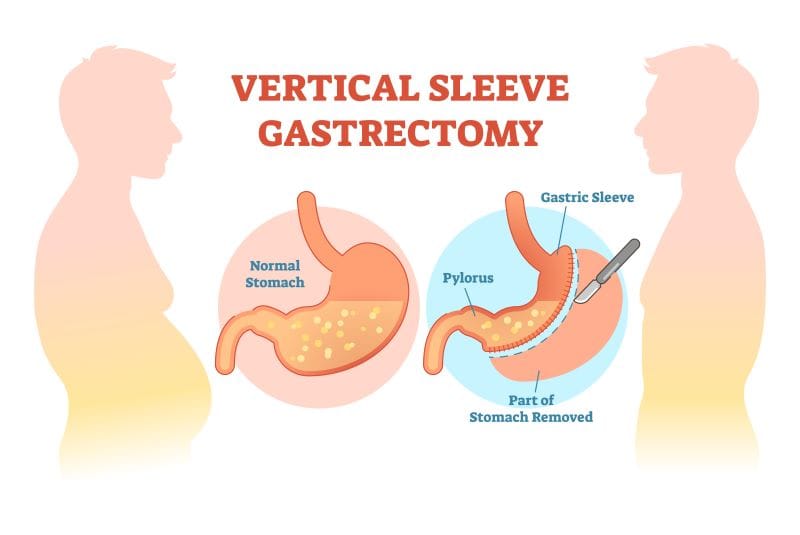 Gastric Sleeve Surgery