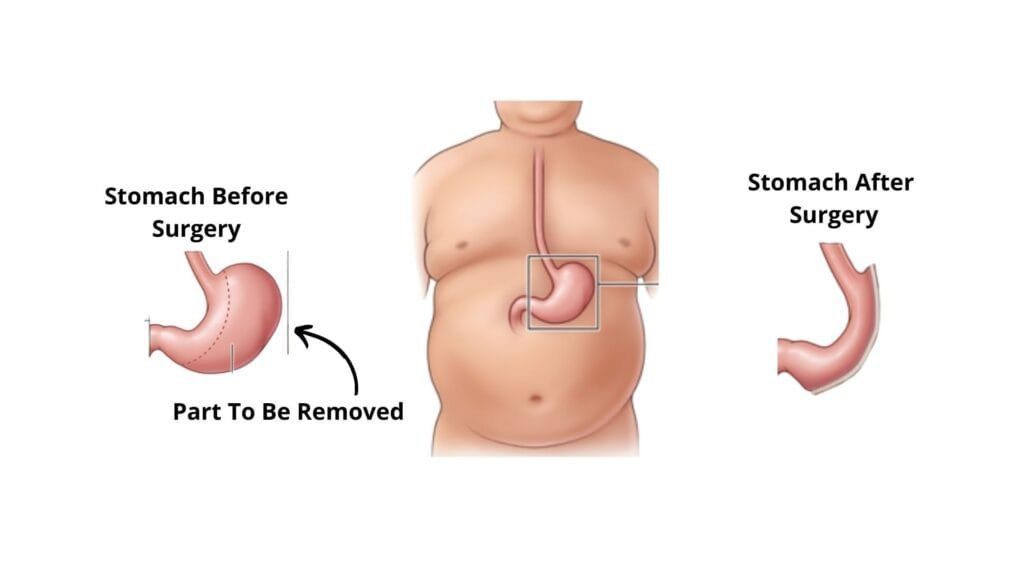 what is a gastric sleeve surgery