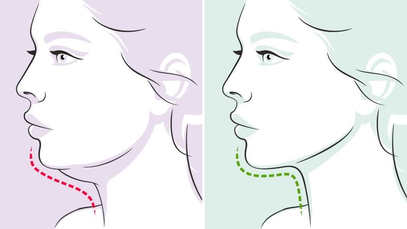 How to Get Rid of Neck Fat