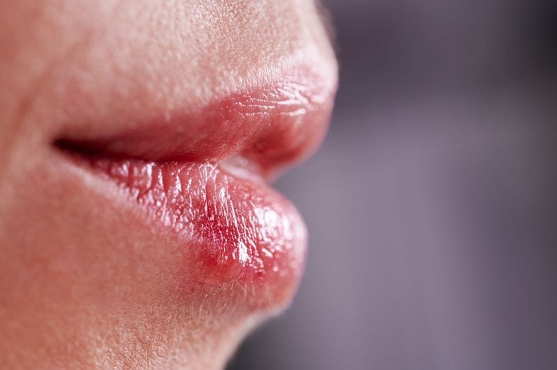 Pimples on lips