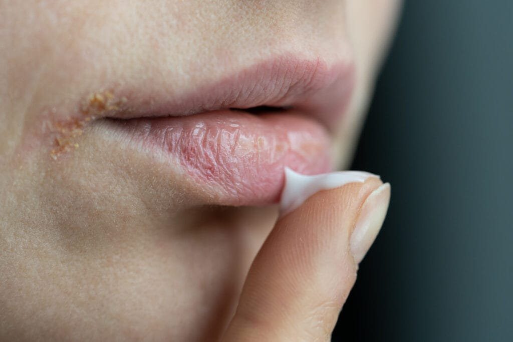 Cold Sore