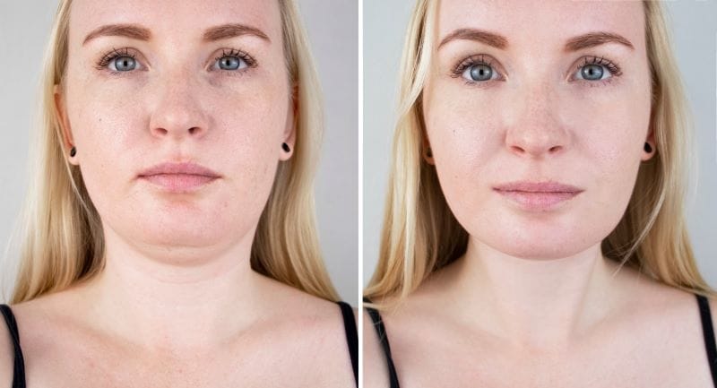 how to get rid of double chin