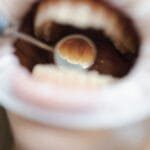 How to Remove Tartar From Teeth: What Works at Home and What Needs a Dentist