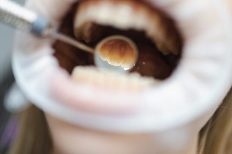 How to Remove Tartar From Teeth: What Works at Home and What Needs a Dentist