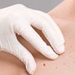 How to Get Rid of Chest Acne: Causes, Treatments and Prevention