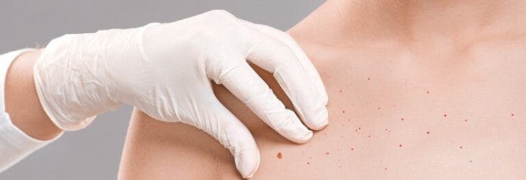 How to Get Rid of Chest Acne: Causes, Treatments and Prevention
