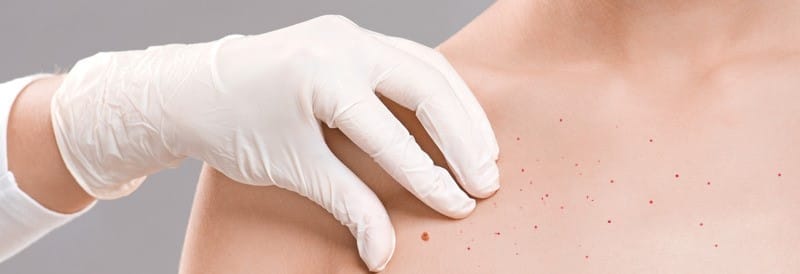 The Ultimate Guide to Treat Chest Acne: