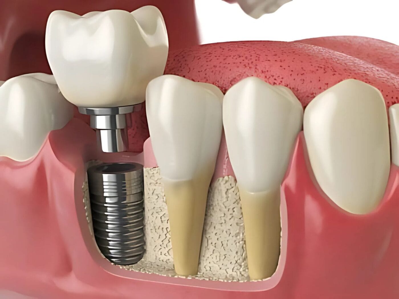 Root Canal Treatment