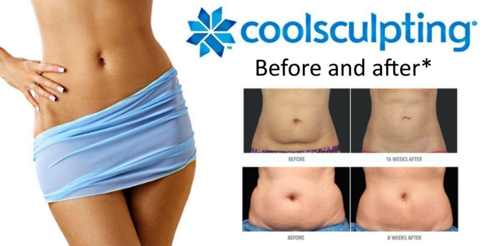 CoolSculpting (Fat Freezing): Results, Side Effects and Who It Suits