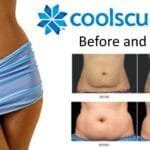 CoolSculpting (Fat Freezing): Results, Side Effects and Who It Suits