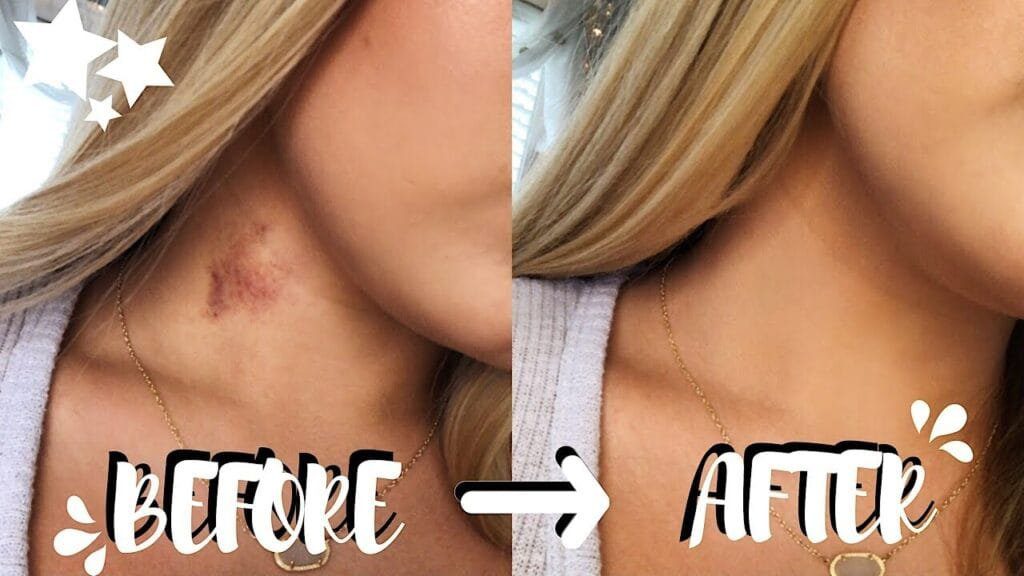 Get Rid of Hickeys