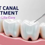 Root Canal Treatment