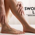 Swollen Legs - edema