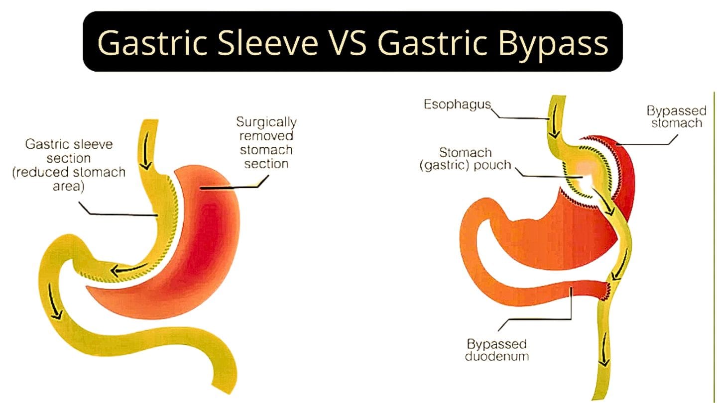 Gastric Sleeve vs Gastric Bypass