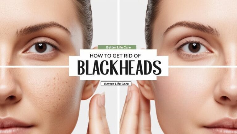 How to Get Rid of Blackheads