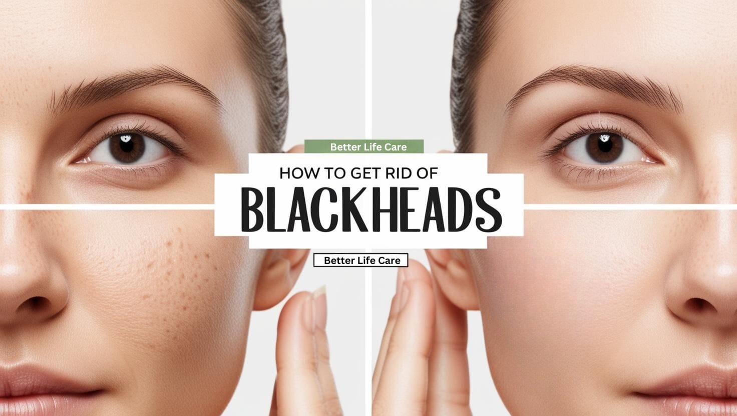 How to Get Rid of Blackheads
