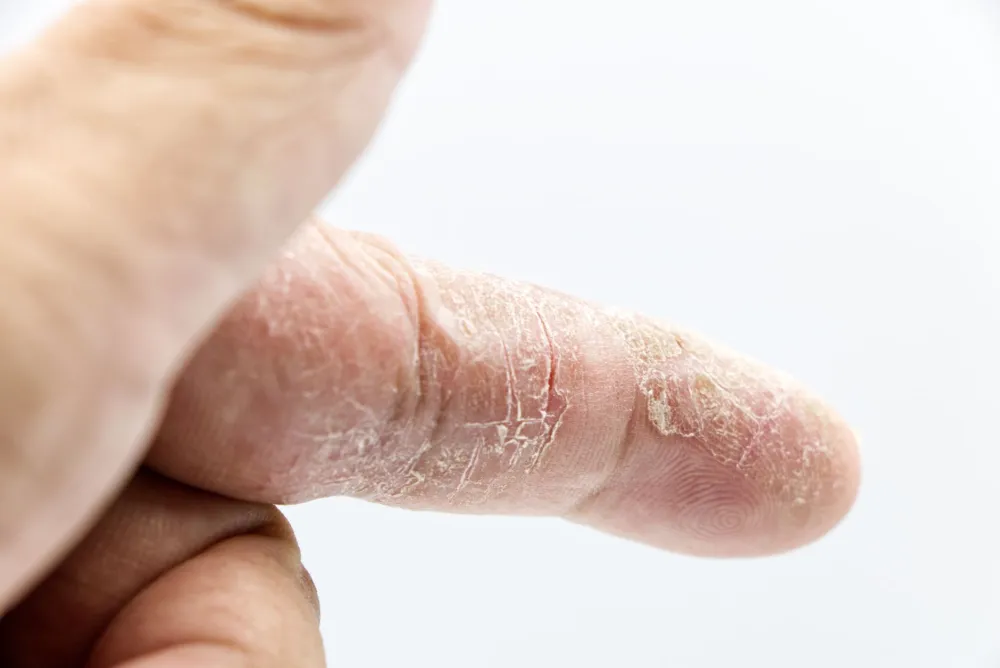 Close-up of dry flaky skin on a person's cheek showing winter skin damage