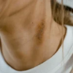 How to Get Rid of a Bruise Fast: What Actually Works