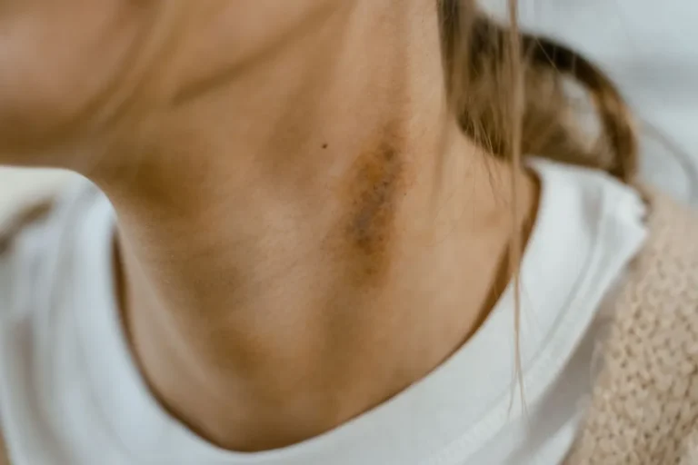How to Get Rid of a Bruise Fast: What Actually Works