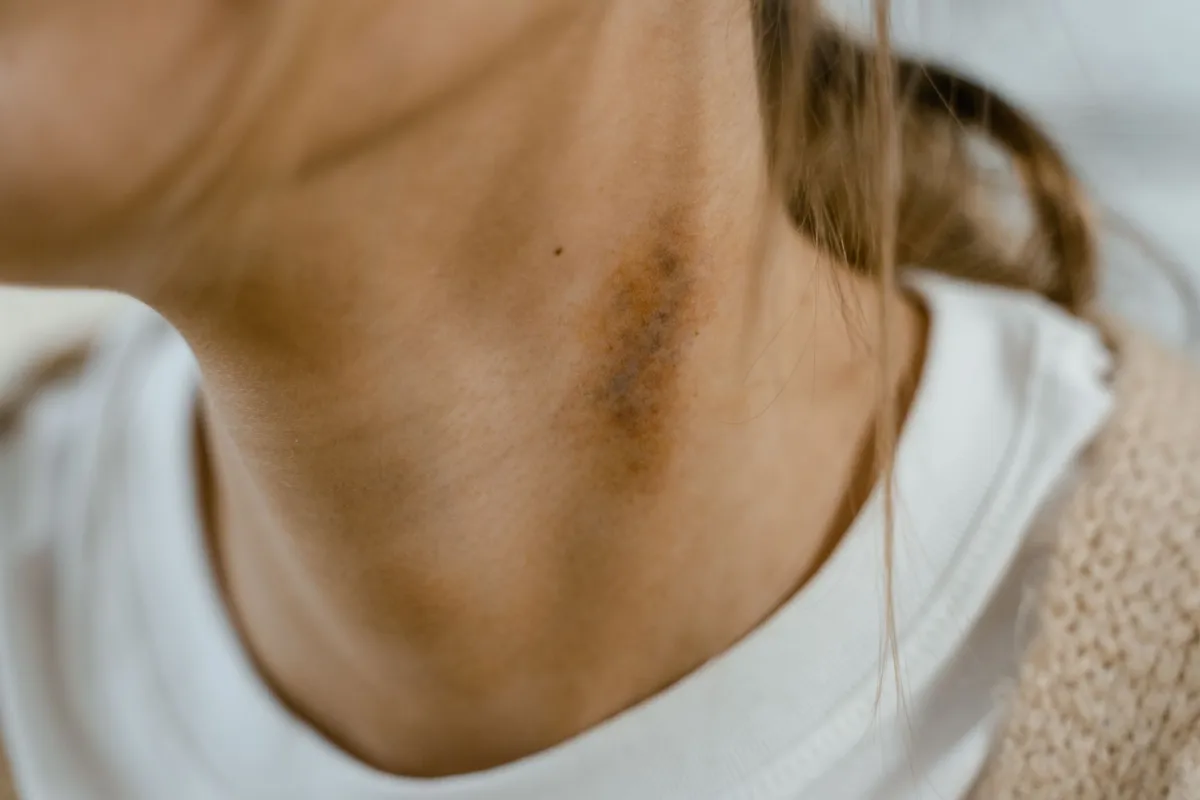 Person applying ice pack to arm bruise to speed up healing