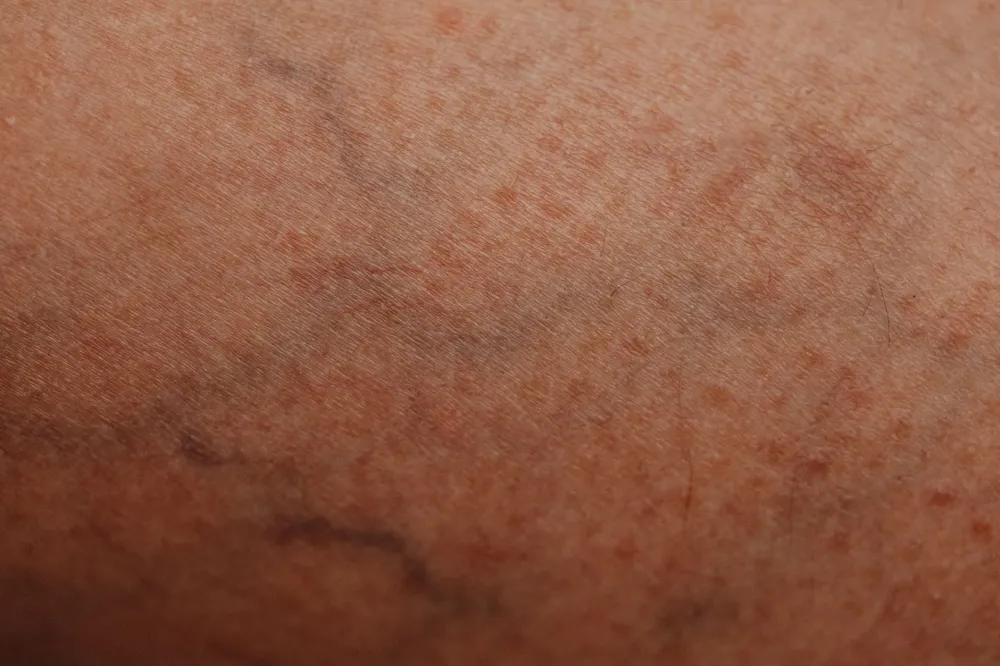 Close-up view of a skin bump showing texture differences for genital area comparison