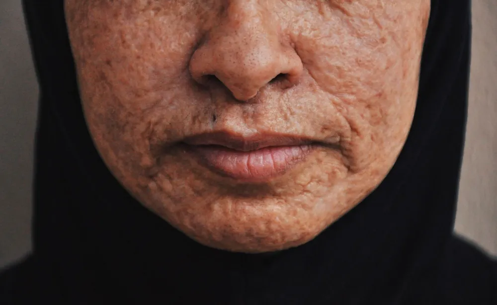 Pimple Inside the Nose: Causes and When to See a Doctor 2 Close-up of nose skin showing pores linked to pimple inside the nose causes