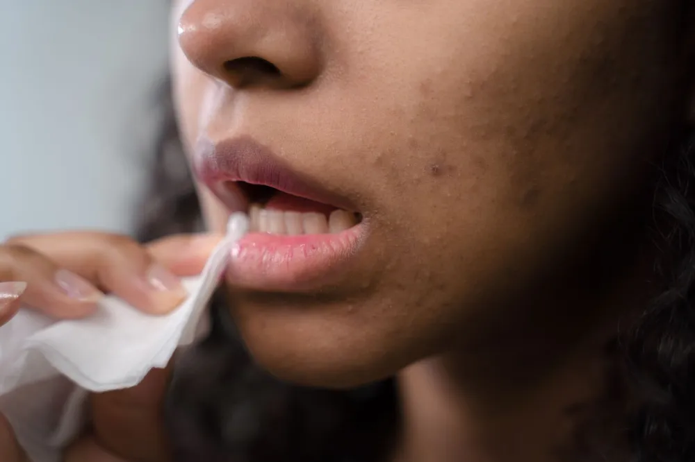 Pimple vs Cold Sore: 7 Simple Clues to Tell Them Apart 2 Close-up of a woman's lips used to compare pimple vs cold sore warning signs